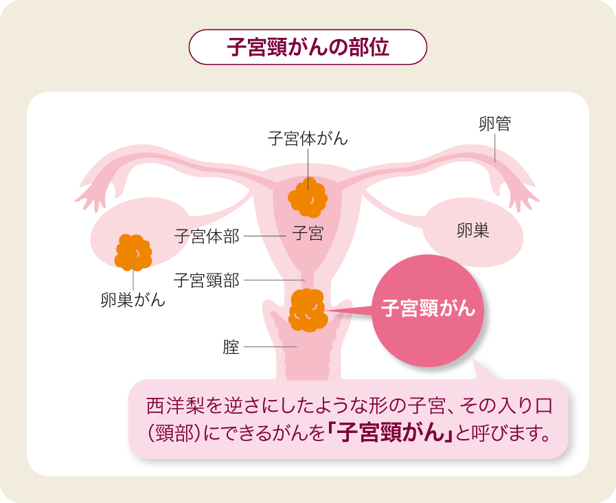 子宮頸がん